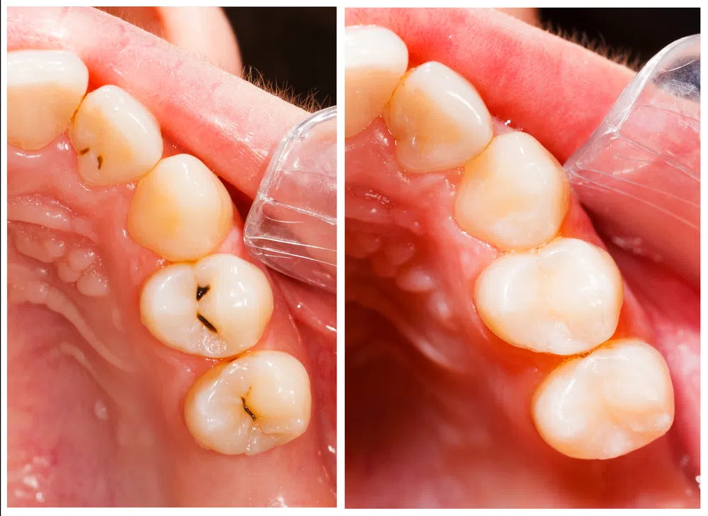 Side by Side Comparison of Tooth Fillings